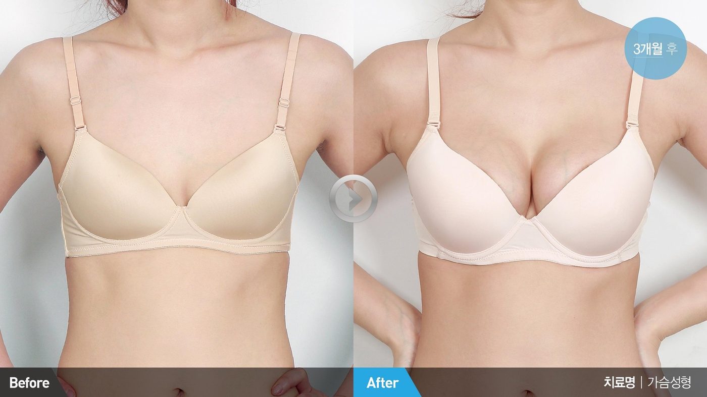 Accessory breast (axillary breast tissue) treatment at Newline Clinic in Busan, Korea