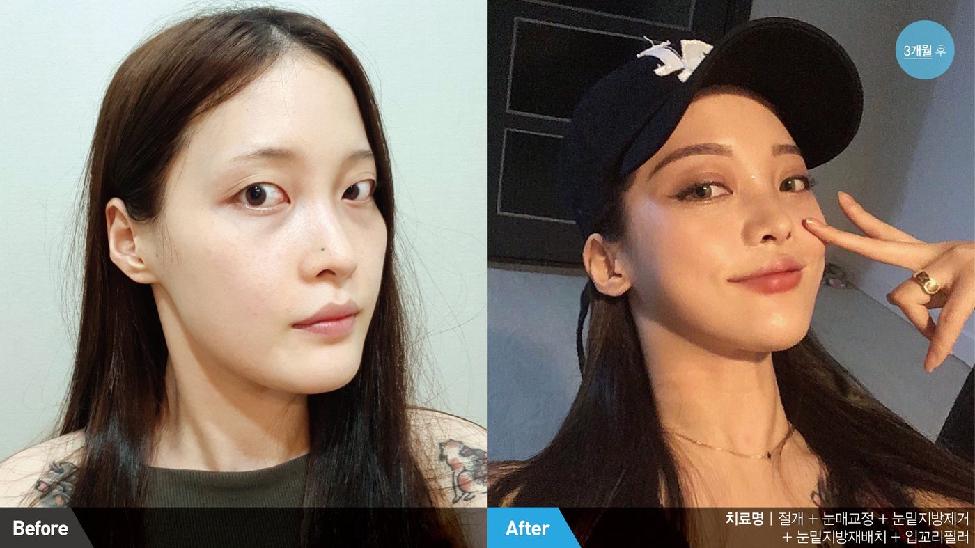 Combined canthoplasty naturally enlarged eyes at Newline Clinic in Busan, Korea