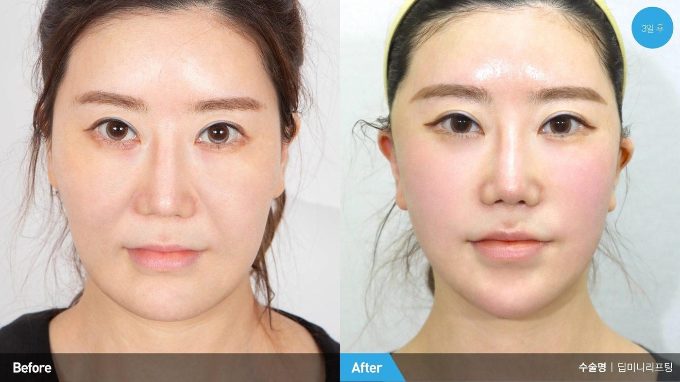 Endoscopic forehead lift natural postoperative portrait at Newline Clinic in Busan, Korea