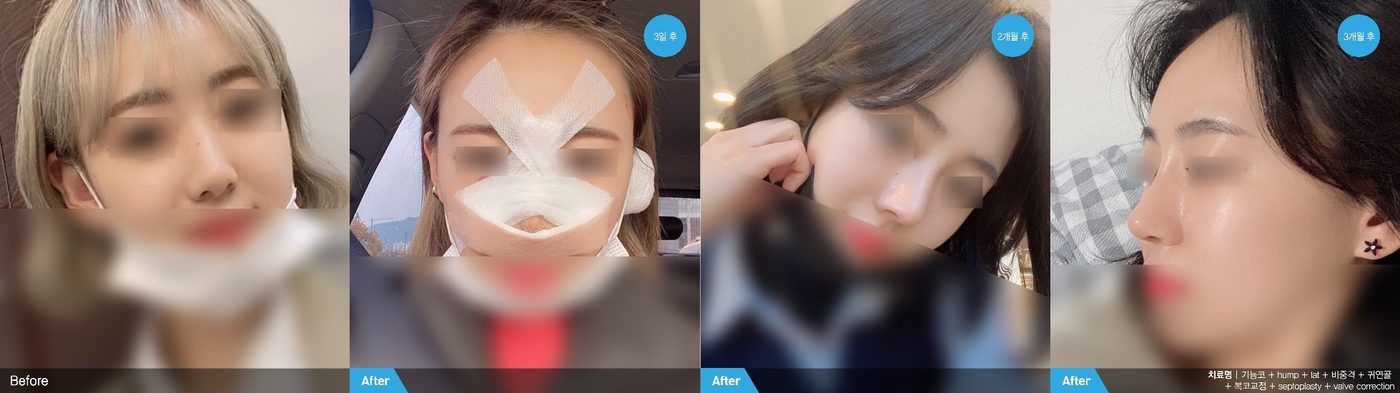 Refined nasal bridge profile after hump nose rhinoplasty at Newline Clinic in Busan, Korea