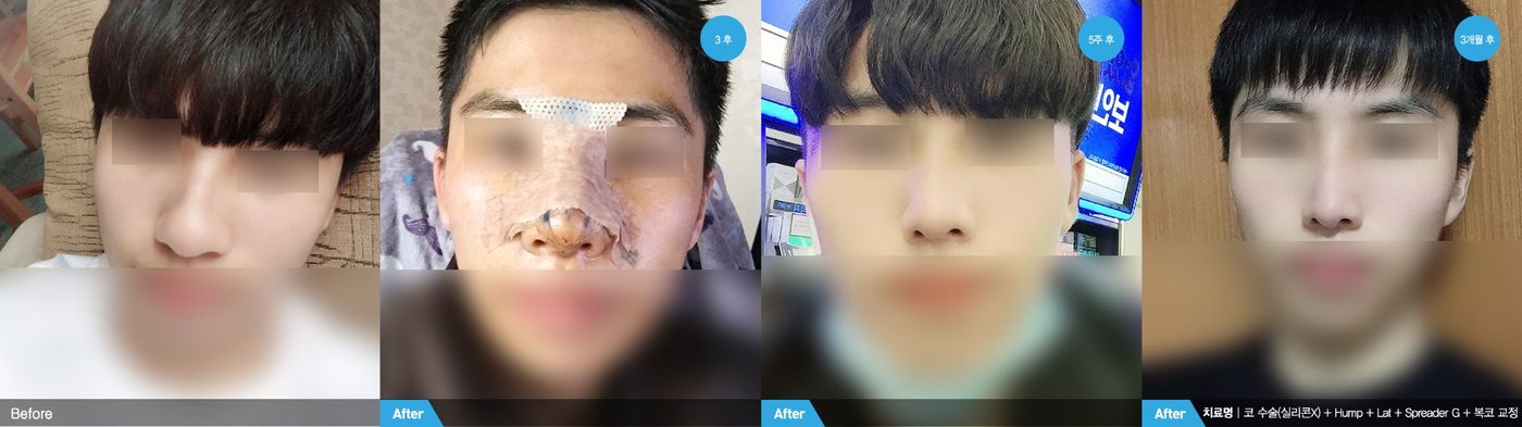 Male rhinoplasty natural masculine nasal profile at Newline Clinic in Busan, Korea