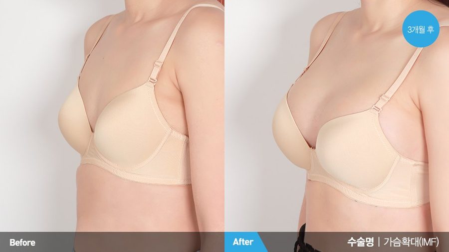 Healed incision after accessory breast surgery — Newline Clinic Busan
