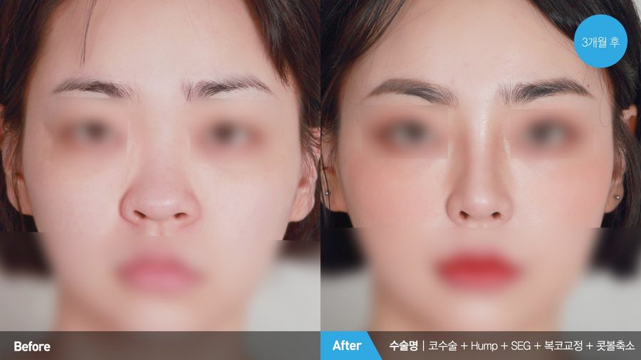 Improved nostril symmetry after alar reduction — Newline Clinic Busan