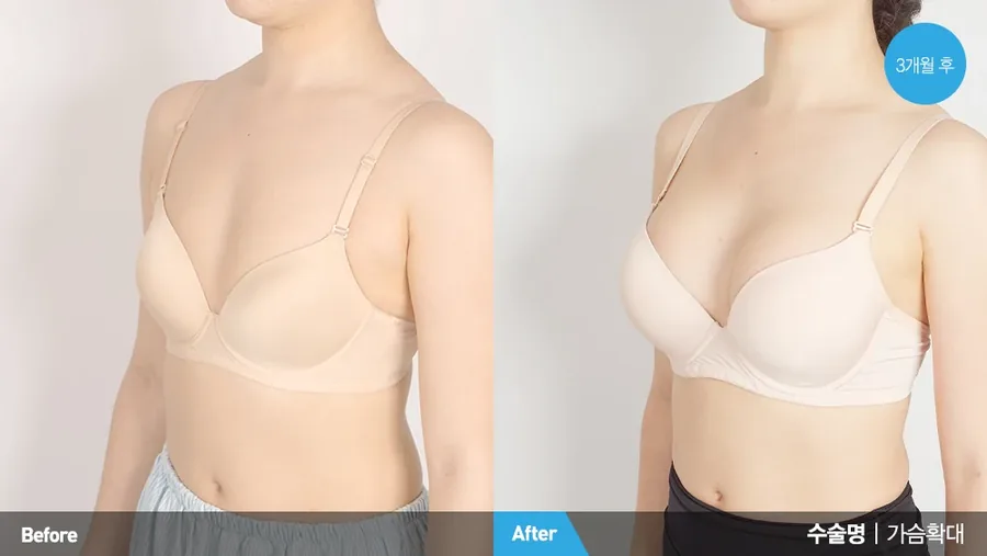 Breast augmentation symmetry result front view — Newline Clinic Busan