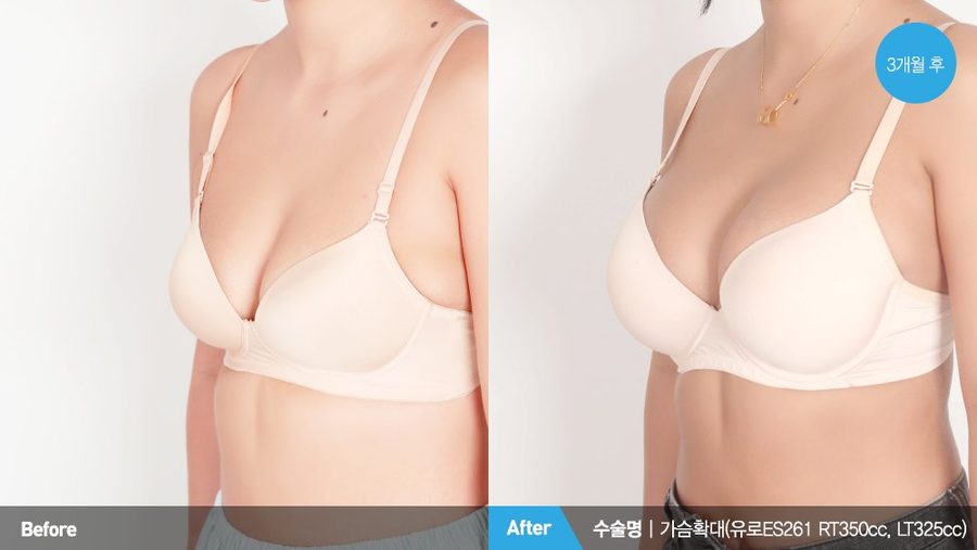 Breast augmentation profile projection result — Newline Clinic Busan