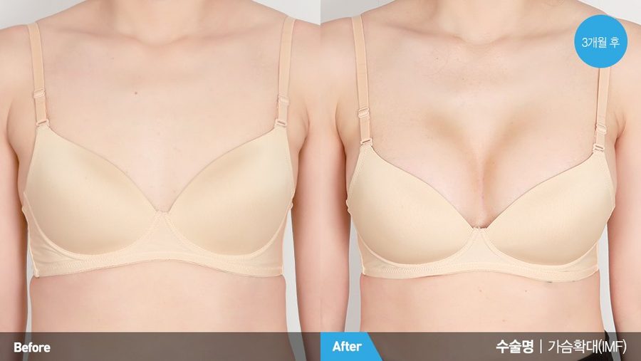 Breast revision surgery before and after front view — Newline Clinic Busan
