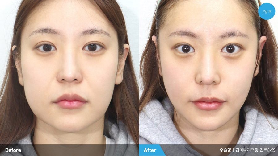Improved brow position after endoscopic forehead lift — Newline Clinic Busan