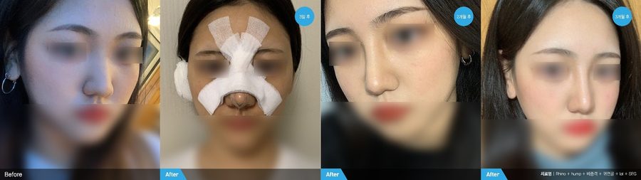 Crooked nose correction before and after front view — Newline Clinic Busan
