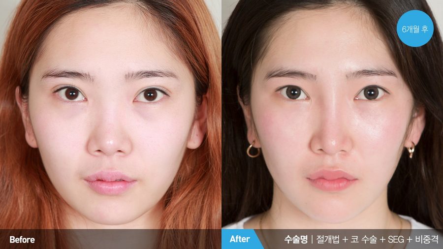 Crooked nose correction profile result — Newline Clinic Busan