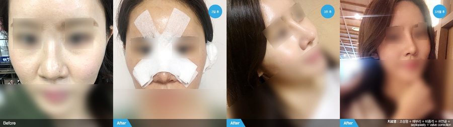 Post-traumatic nasal deviation corrected — Newline Clinic Busan