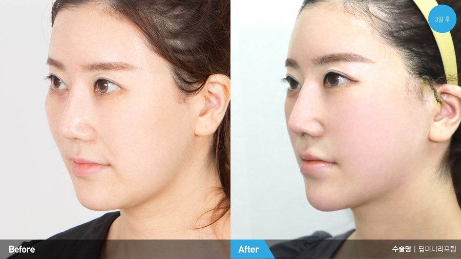 Deep Mini Lift before and after front view — Newline Clinic Busan