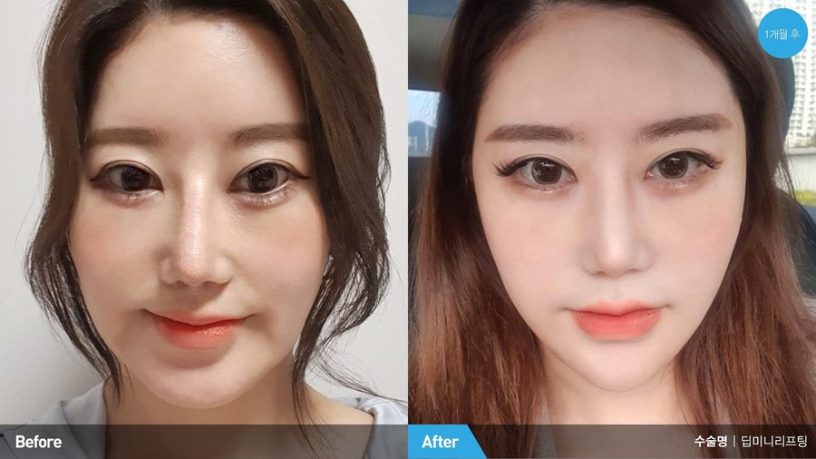Healed hidden hairline incision after Deep Mini Lift — Newline Clinic Busan