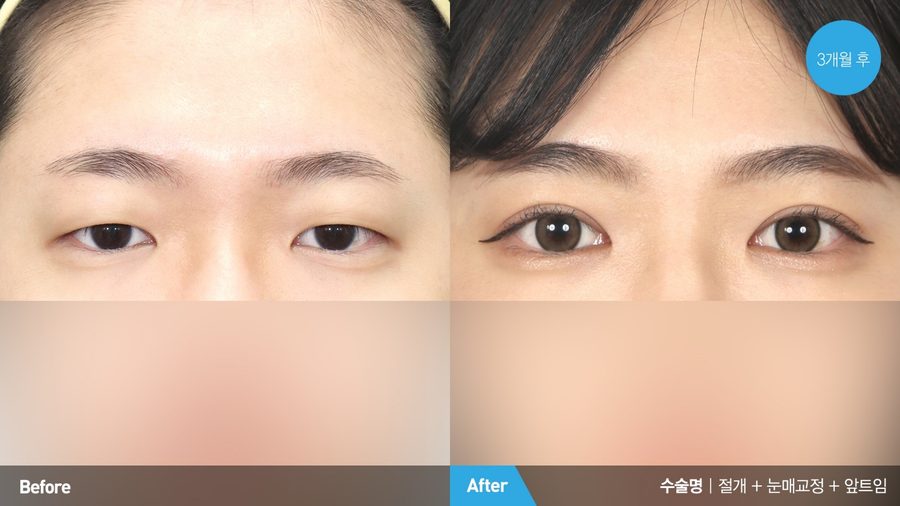 Combined eyelid procedures result — Newline Clinic Busan