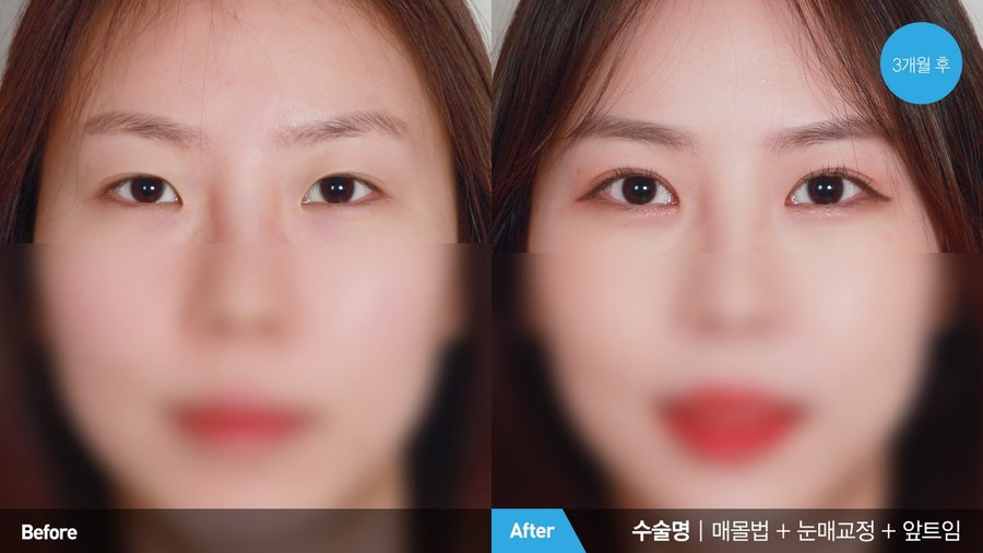 Incisional double eyelid surgery result — Newline Clinic Busan