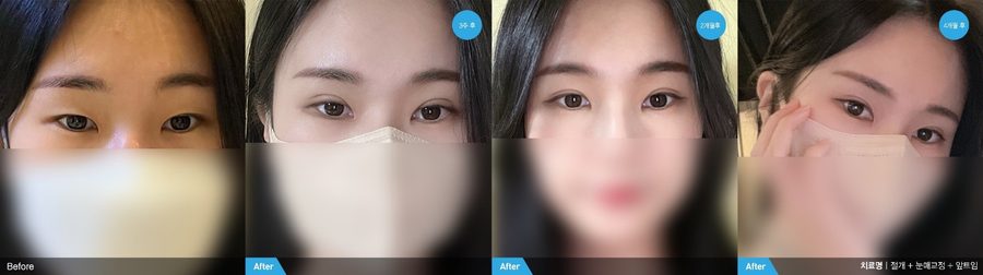 Ptosis correction result — Newline Clinic Busan