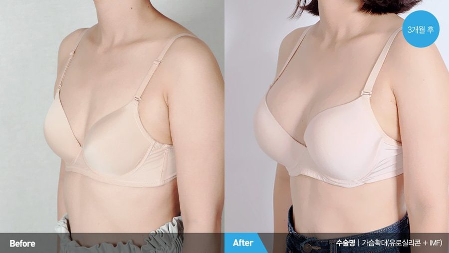 Temple volume restoration after PRP fat grafting — Newline Clinic Busan