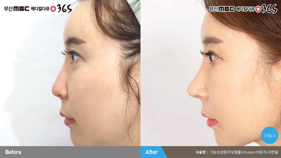 Septal deviation correction result — Newline Clinic Busan