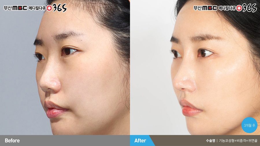 Improved nasal symmetry after functional rhinoplasty — Newline Clinic Busan