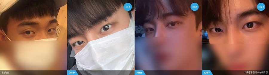 Male double eyelid surgery before and after front view — Newline Clinic Busan