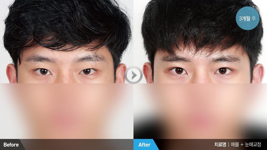 Non-incisional male double eyelid result — Newline Clinic Busan