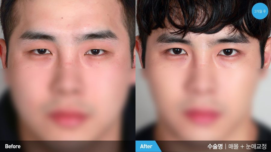Male ptosis correction improving pupil exposure — Newline Clinic Busan