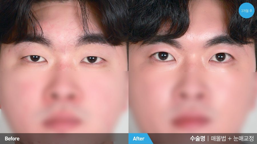 Incisional male double eyelid surgery result — Newline Clinic Busan