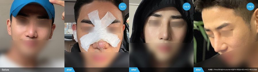 Male rhinoplasty front view result — Newline Clinic Busan