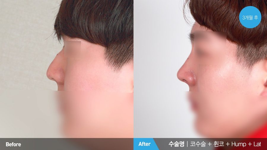 Controlled tip rotation in male rhinoplasty — Newline Clinic Busan