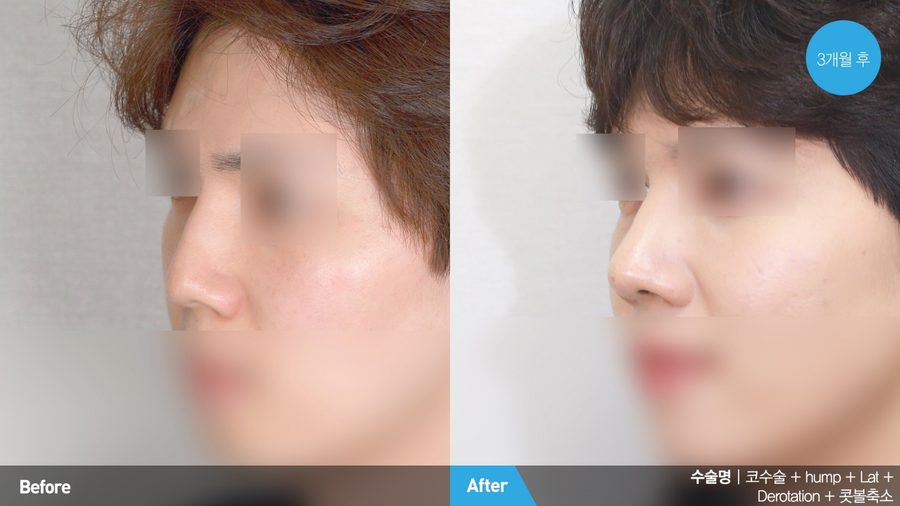 Dorsal hump correction for male patient — Newline Clinic Busan