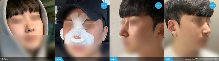 Male plastic surgery before and after front view — Newline Clinic Busan