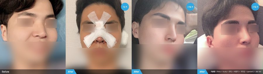 Masculine nasal profile result — Newline Clinic Busan