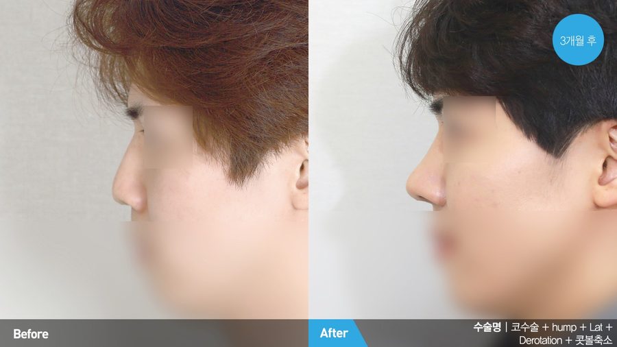Balanced facial proportions after male plastic surgery — Newline Clinic Busan