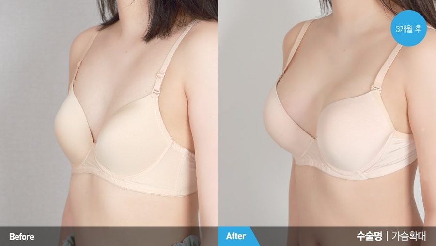 Mentor MemoryGel Xtra side profile result — Newline Clinic Busan