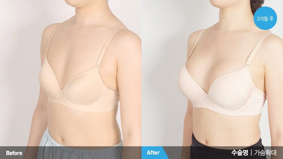 Breast symmetry with Mentor MemoryGel Xtra implants — Newline Clinic Busan