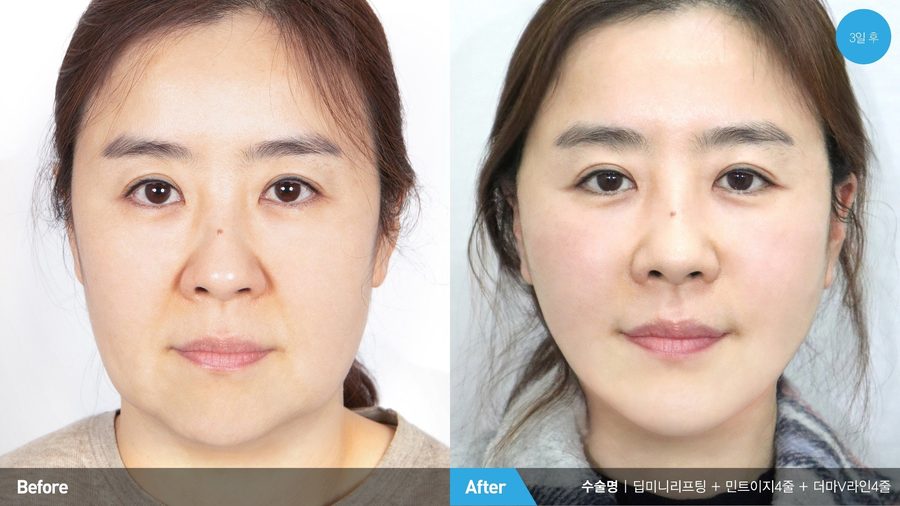 Mini facelift profile result — Newline Clinic Busan