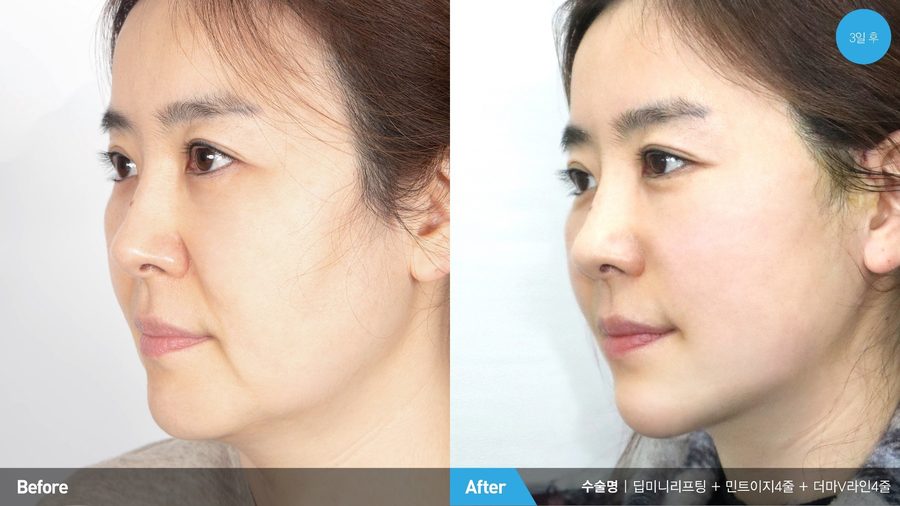 Natural expression preserved after mini facelift — Newline Clinic Busan