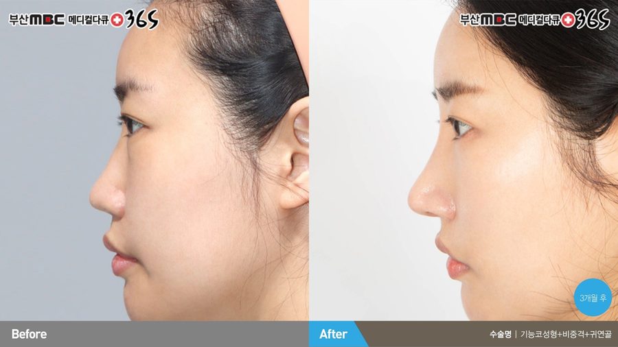 Nasal valve reconstruction before and after front view — Newline Clinic Busan