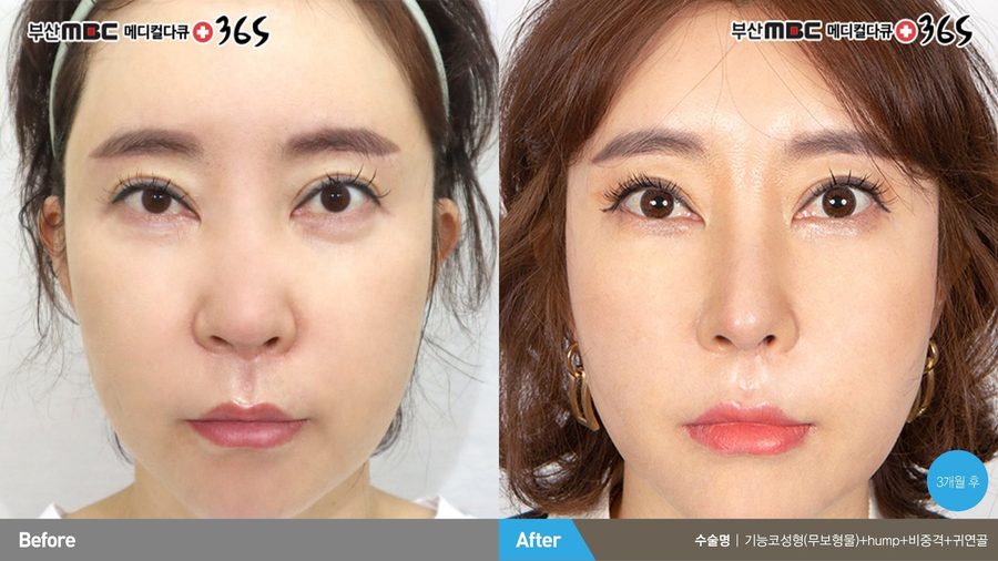 Preserved natural nasal contour after valve reconstruction — Newline Clinic Busan
