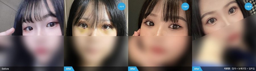 Ptosis correction before and after front view — Newline Clinic Busan