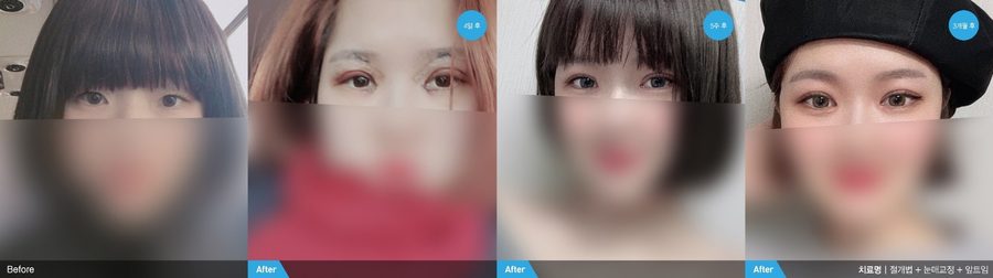 Incisional ptosis correction result — Newline Clinic Busan
