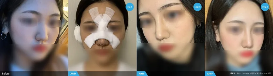 Rhinoplasty before and after front view — Newline Clinic Busan