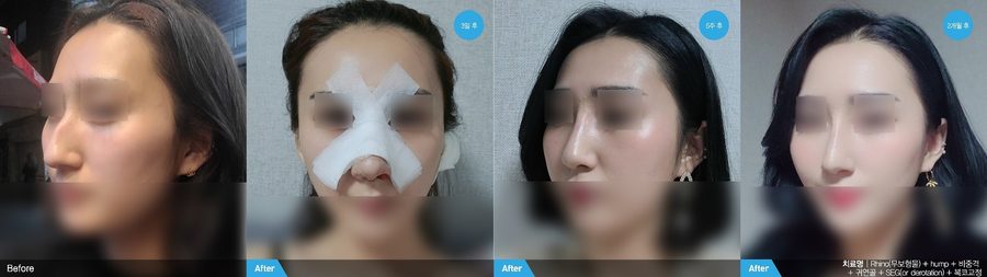 Rhinoplasty right profile result — Newline Clinic Busan