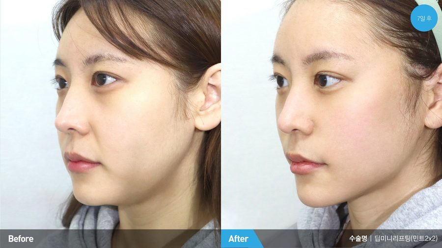 Reduced jowls after SMAS facelift — Newline Clinic Busan