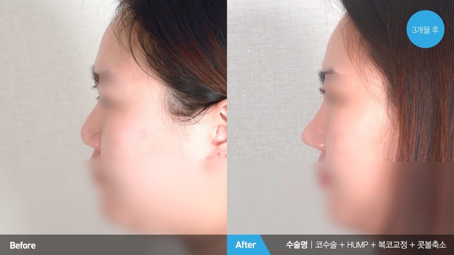 Facial balance after nasal tip refinement — Newline Clinic