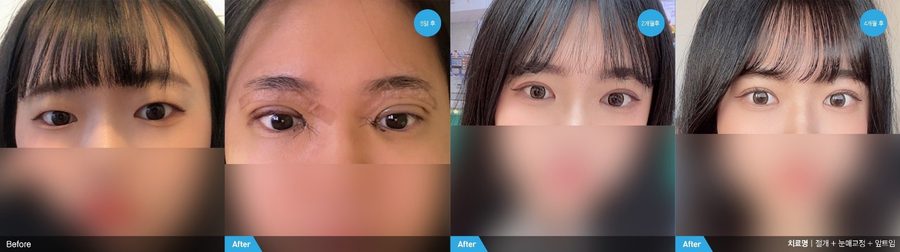 Upper eyelid profile result after blepharoplasty — Newline Clinic Busan